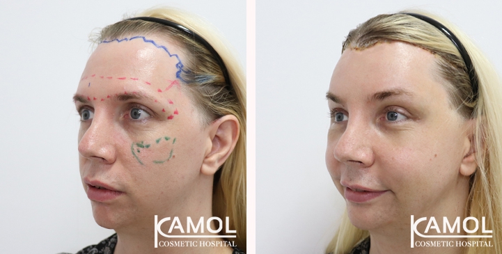 Cheek Augmentation,Hairline lowering,Forehead Lift,Forehead compression,Eye Brow Lift