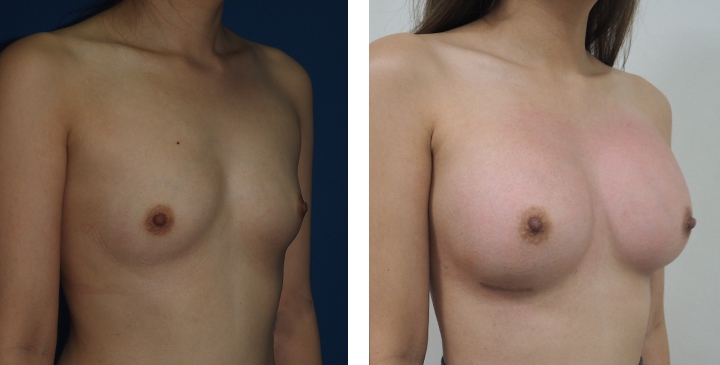 Male to Female Breast Surgery