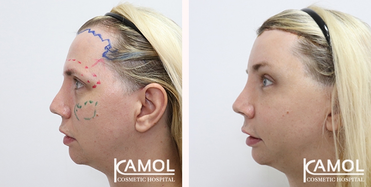 Cheek Augmentation,Hairline lowering,Forehead Lift,Forehead compression,Eye Brow Lift