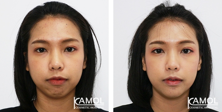 Before and After Chin Augmentation, Chin Implant