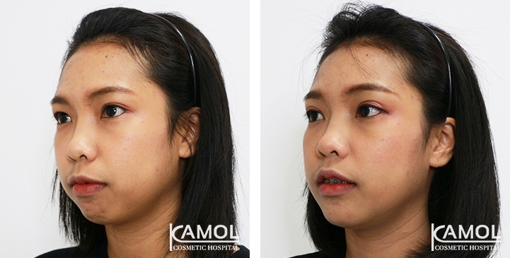 Before and After Chin Augmentation, Chin Implant