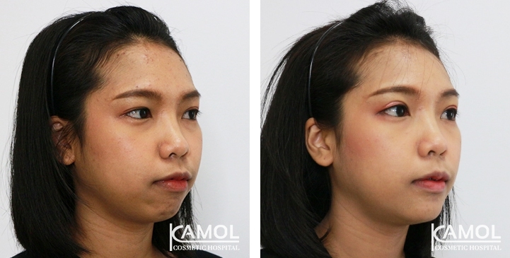 Before and After Chin Augmentation, Chin Implant