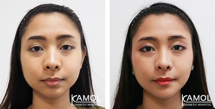 Before and After Chin Augmentation, Chin Implant