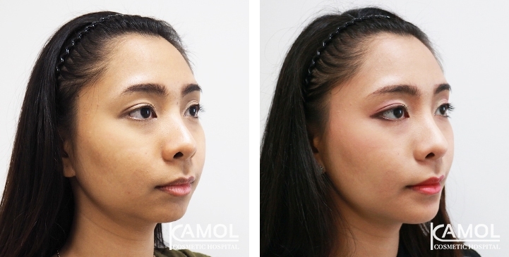 Before and After Chin Augmentation, Chin Implant