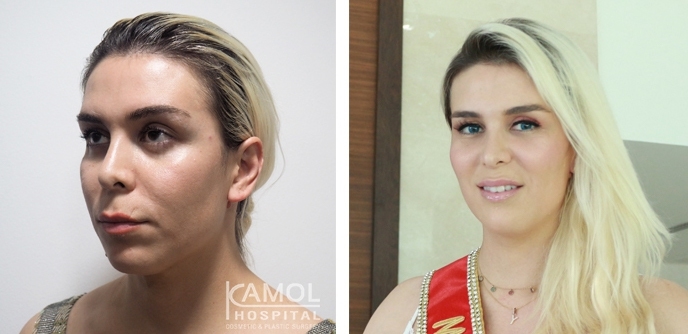 Before and After Side chin reduction and Chin Augmentation, Chin Implant