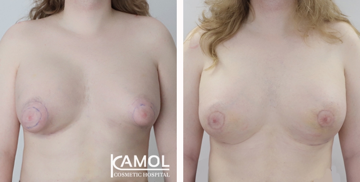 Male to Female Breast Surgery