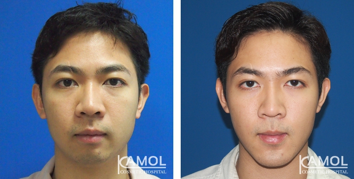 Before and After Genitoplasty, Chin Forward Sliding