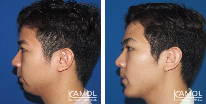 Before and After Genitoplasty, Chin Forward Sliding