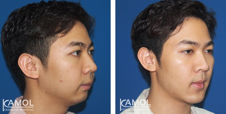 Before and After Genitoplasty, Chin Forward Sliding