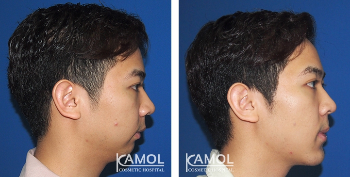 Before and After Genitoplasty, Chin Forward Sliding