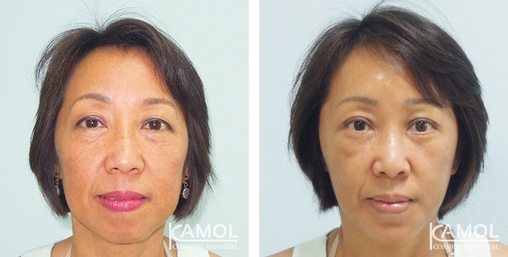 Before and After Genitoplasty, Chin Forward Sliding