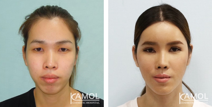 Before and After Genitoplasty, Chin Forward Sliding