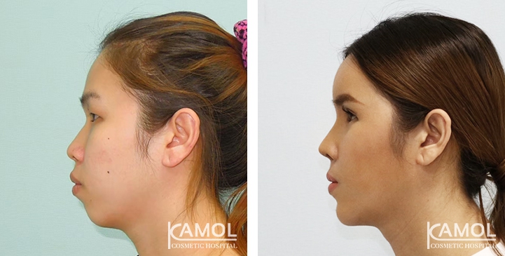 Before and After Genitoplasty, Chin Forward Sliding