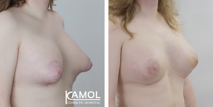 Male to Female Breast Surgery