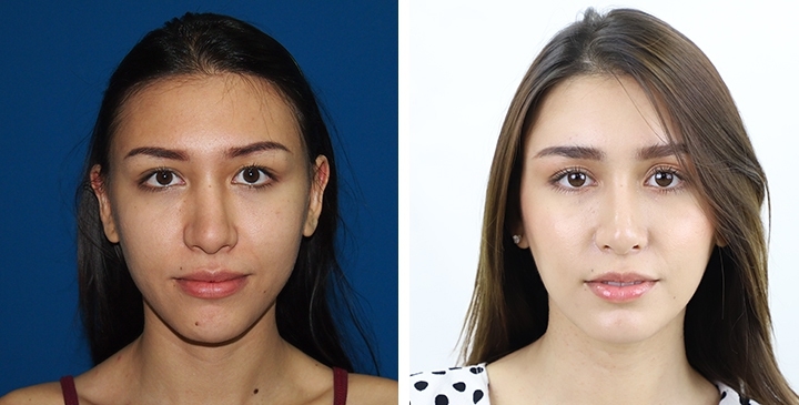 Before and After  Chin to Jaw Reduction