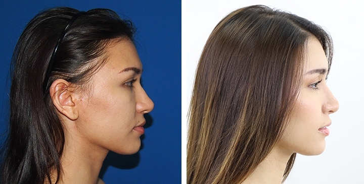 Before and After  Chin to Jaw Reduction