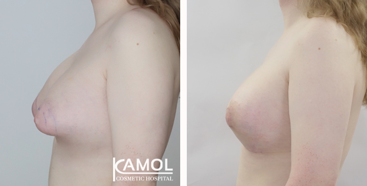 Male to Female Breast Surgery