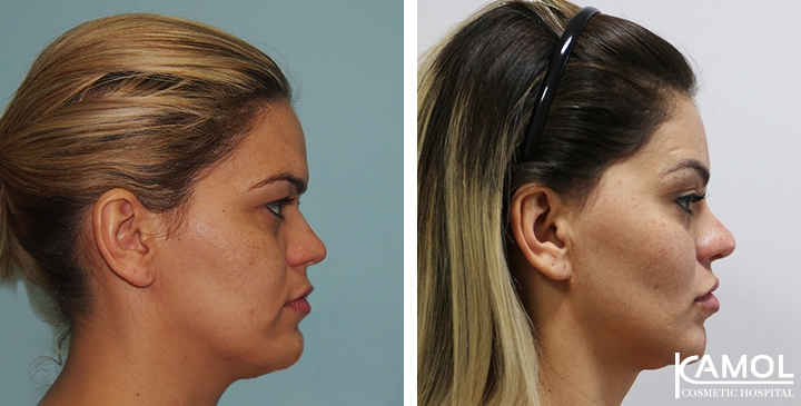 Before and After  Chin to Jaw Reduction (Long horse shoe)