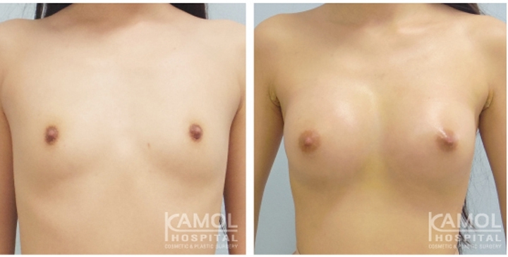 Male to Female Breast Surgery