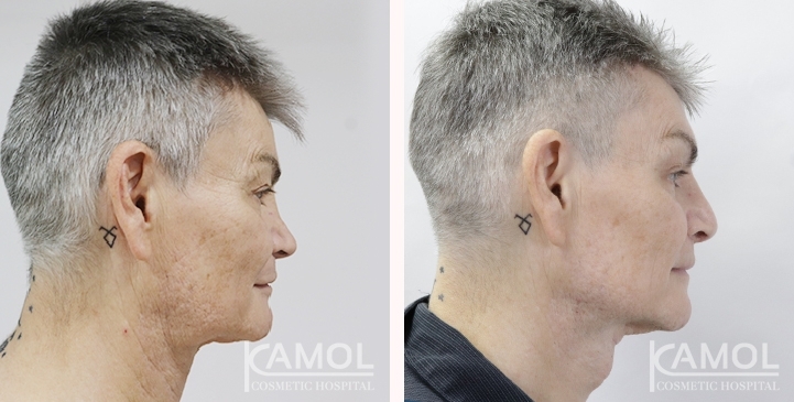 Before & After Masculin Nose, Jaw Augmentation, Chin Augmentation, Adam's Apple Augmentation, Front view