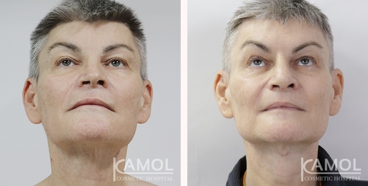 Before & After Masculin Nose, Jaw Augmentation, Chin Augmentation, Adam's Apple Augmentation, Left side view