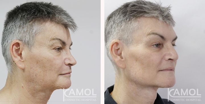 Before & After Masculin Nose, Jaw Augmentation, Chin Augmentation, Adam's Apple Augmentation, Left side view