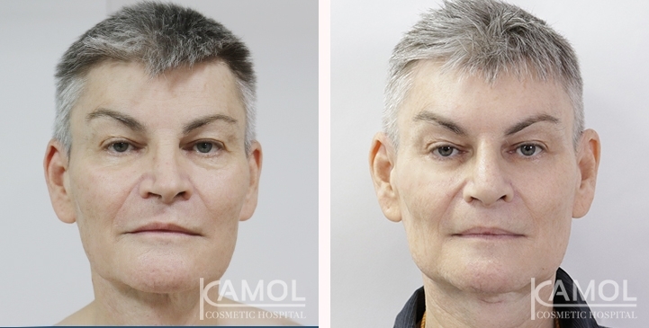 Before & After Masculin Nose, Jaw Augmentation, Chin Augmentation, Adam's Apple Augmentation, Right side view