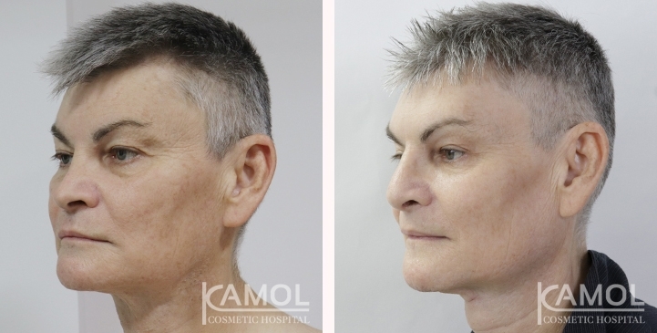 Before & After Masculin Nose, Jaw Augmentation, Chin Augmentation, Adam's Apple Augmentation, Right side view