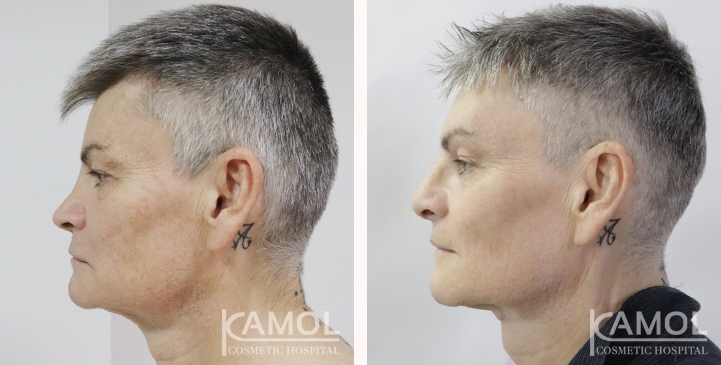 Before & After Masculin Nose, Jaw Augmentation, Chin Augmentation, Adam's Apple Augmentation, Right side view