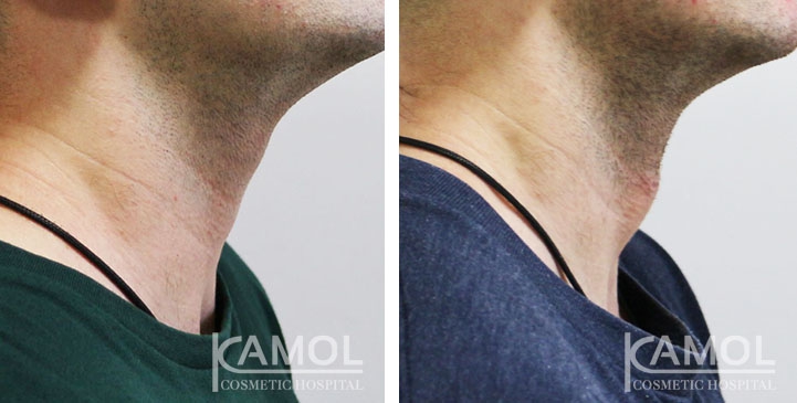 Adam’s apple Augmentation Surgery, Right side view