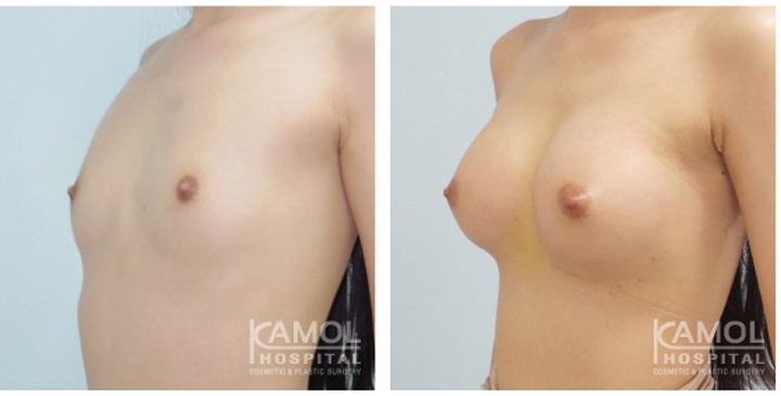 Male to Female Breast Surgery