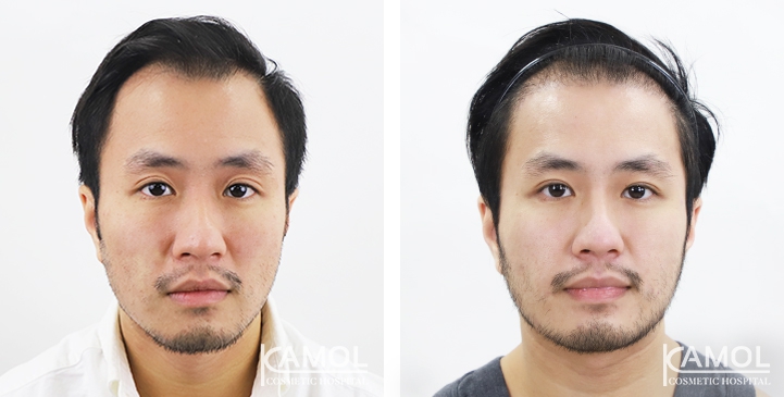 Before & After Masculin Hairline, Front view