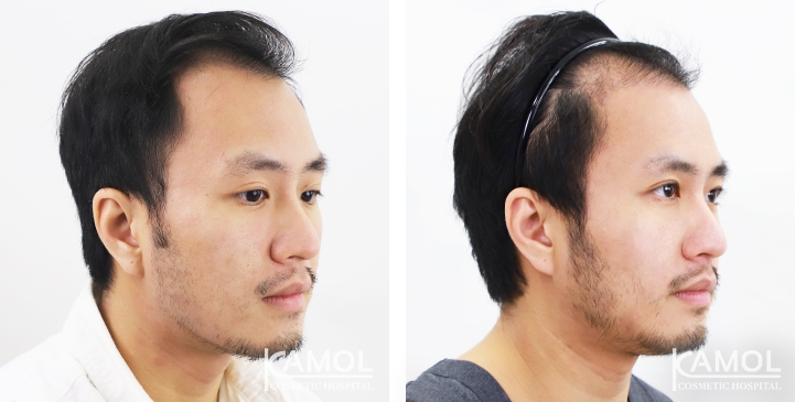 Before & After Masculin Hairline, Left side view