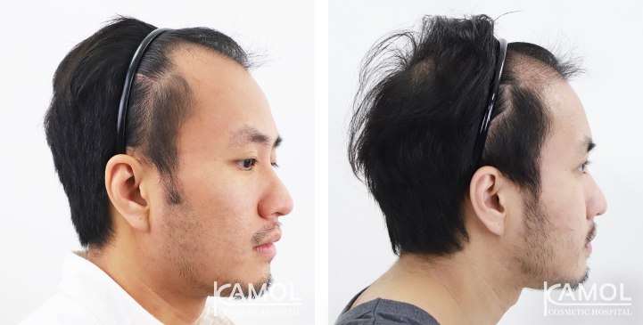 Before & After Masculin Hairline, Left side view