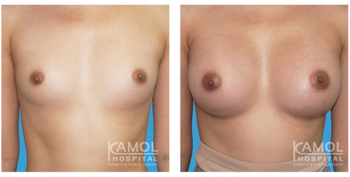 Male to Female Breast Surgery