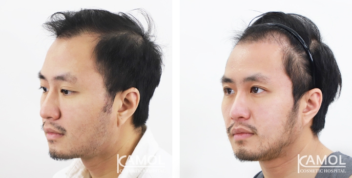 Before & After Masculin Hairline, Right side view