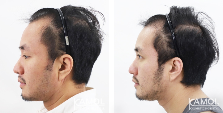 Before & After Masculin Hairline, Right side view