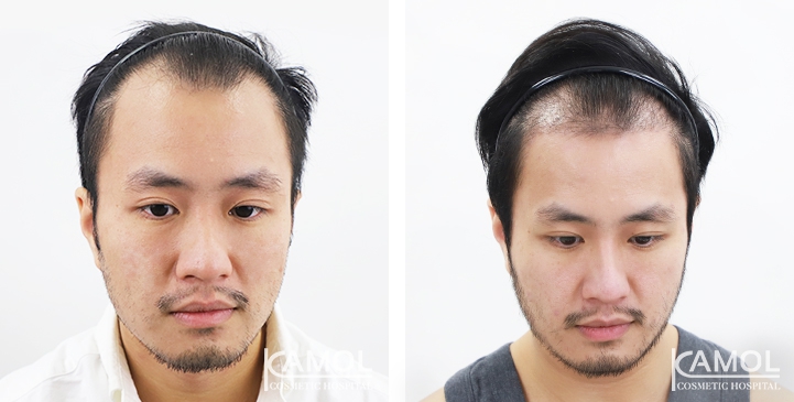 Before & After Masculin Hairline, Top view