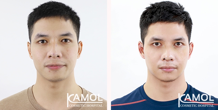 Before & After Masculin Nose, Front view