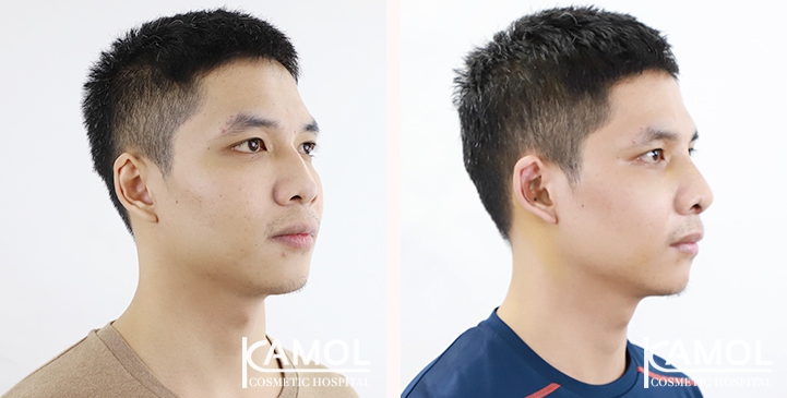 Before & After Masculin Nose, Left side view