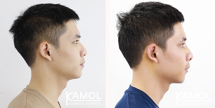 Before & After Masculin Nose, Left side view