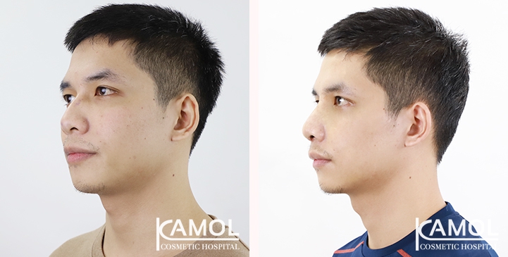 Before & After Masculin Nose, Right side view