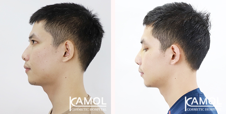Before & After Masculin Nose, Right side view