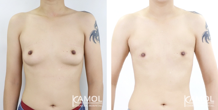 Before and After Mastectomy (Top Surgery) U-Shape Scar technique
