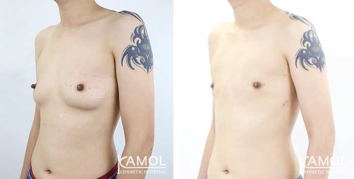 Before and After Mastectomy (Top Surgery) U-Shape Scar technique