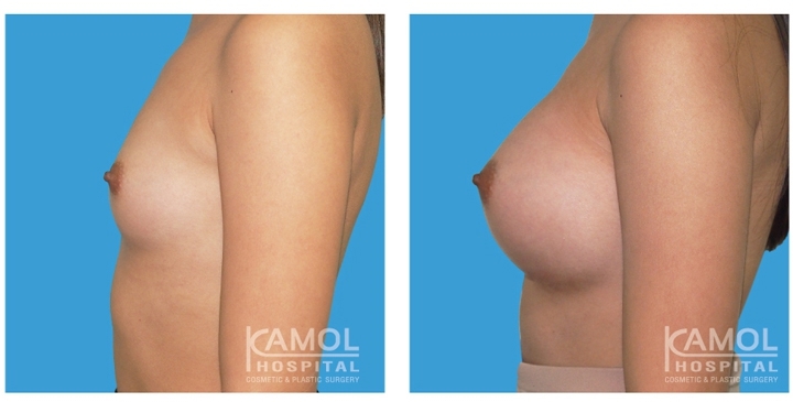 Male to Female Breast Surgery