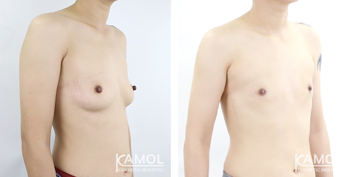 Before and After Mastectomy (Top Surgery) U-Shape Scar technique