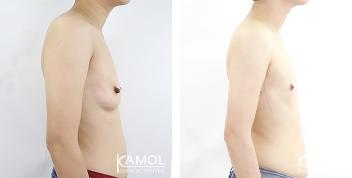 Before and After Mastectomy (Top Surgery) U-Shape Scar technique