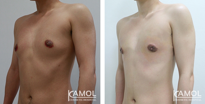 Before and After Mastectomy (Top Surgery)  U-Shape Scar technique