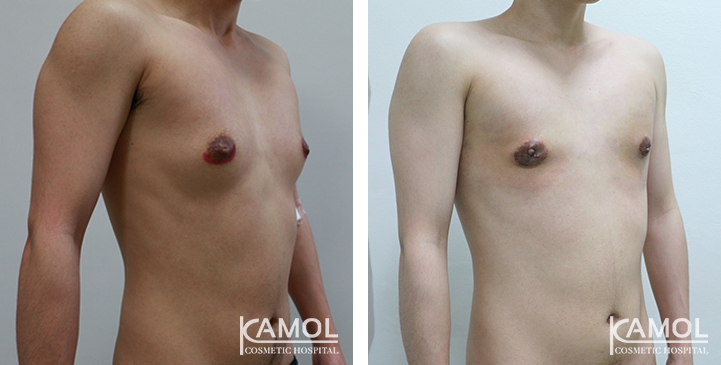 Before and After Mastectomy (Top Surgery)  U-Shape Scar technique